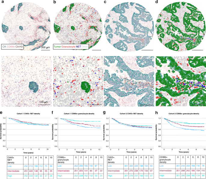Significance of tumor infiltrating granulocytes and neutrophil extracellular traps in colorectal cancer