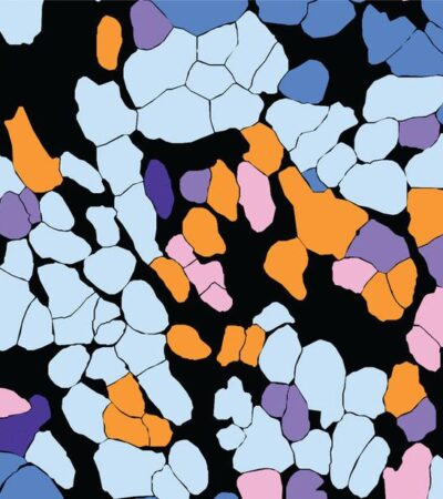 Single-cell TCR mapping reveals spatially coordinated T cell states in head and neck cancer | Science Immunology