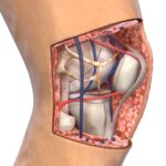 What Causes a Patellar Tendon Tear and How to Treat It