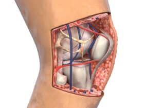 What Causes a Patellar Tendon Tear and How to Treat It