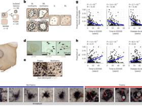 Foamy microglia link oxylipins to disease progression in multiple sclerosis