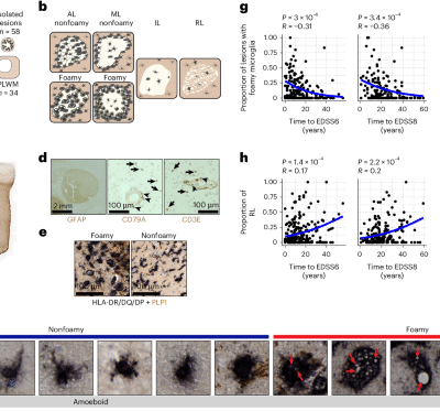 Foamy microglia link oxylipins to disease progression in multiple sclerosis