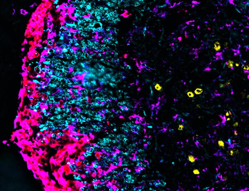 Monocyte-derived macrophages drive neurological tissue damage through mitochondrial reactive oxygen species | Science Immunology
