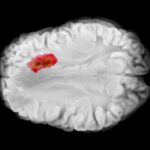 NIH-funded study suggests that testosterone suppresses brain tumor growth in males