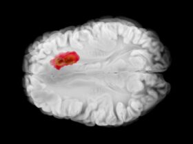 NIH-funded study suggests that testosterone suppresses brain tumor growth in males