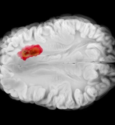 NIH-funded study suggests that testosterone suppresses brain tumor growth in males