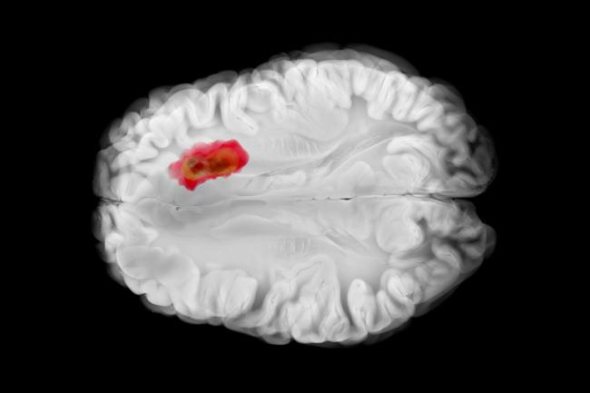 NIH-funded study suggests that testosterone suppresses brain tumor growth in males