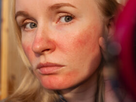 Researchers Explain What The Redness On Your Face Actually Is