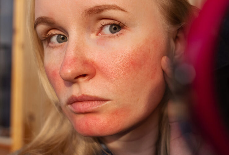 Researchers Explain What The Redness On Your Face Actually Is