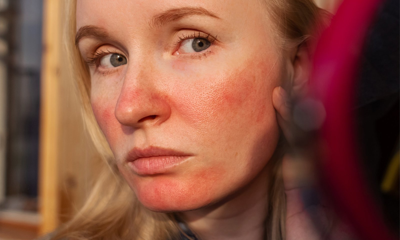 Researchers Explain What The Redness On Your Face Actually Is